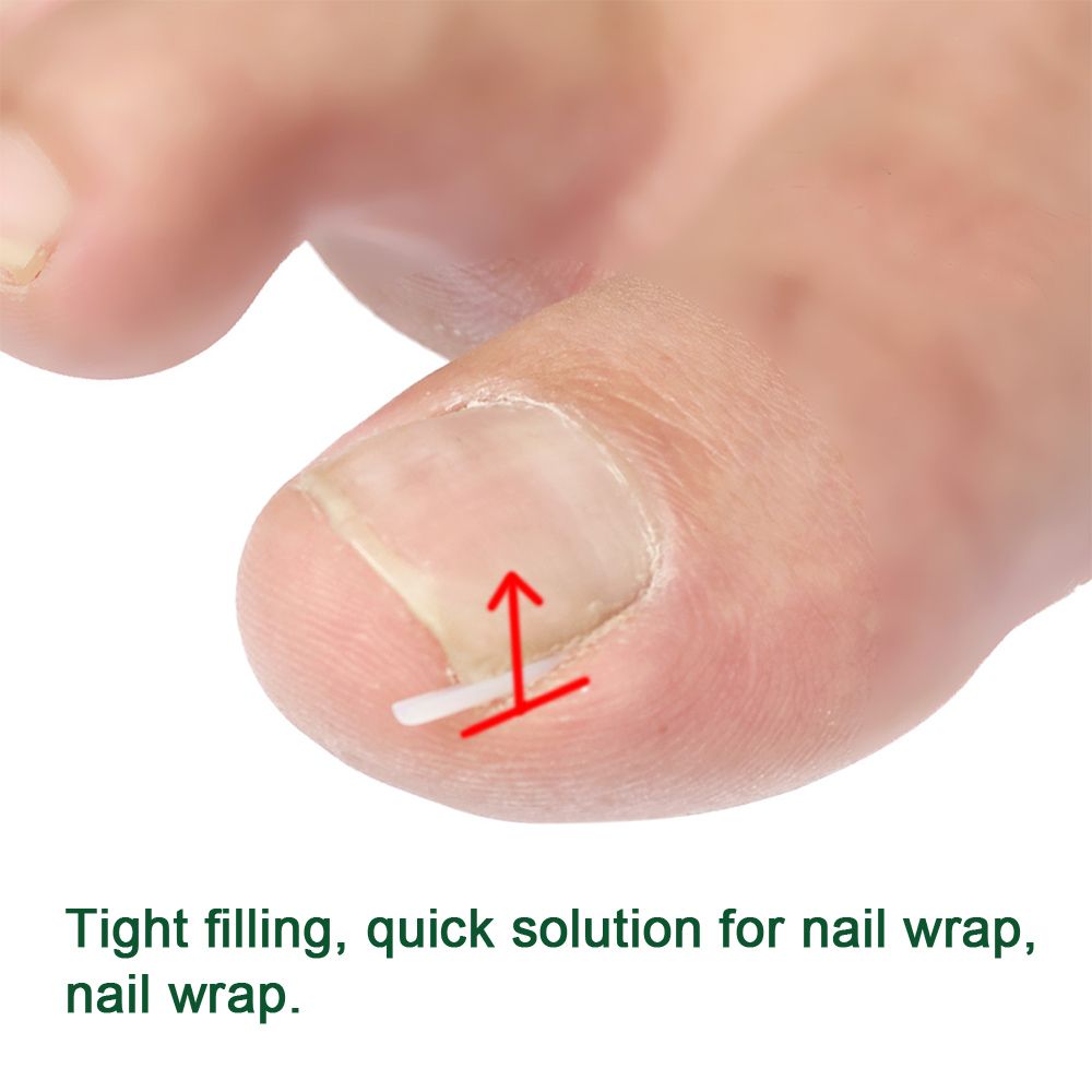 10PCS Ingrown Toenail Corrector Pad Foot Care Straightening