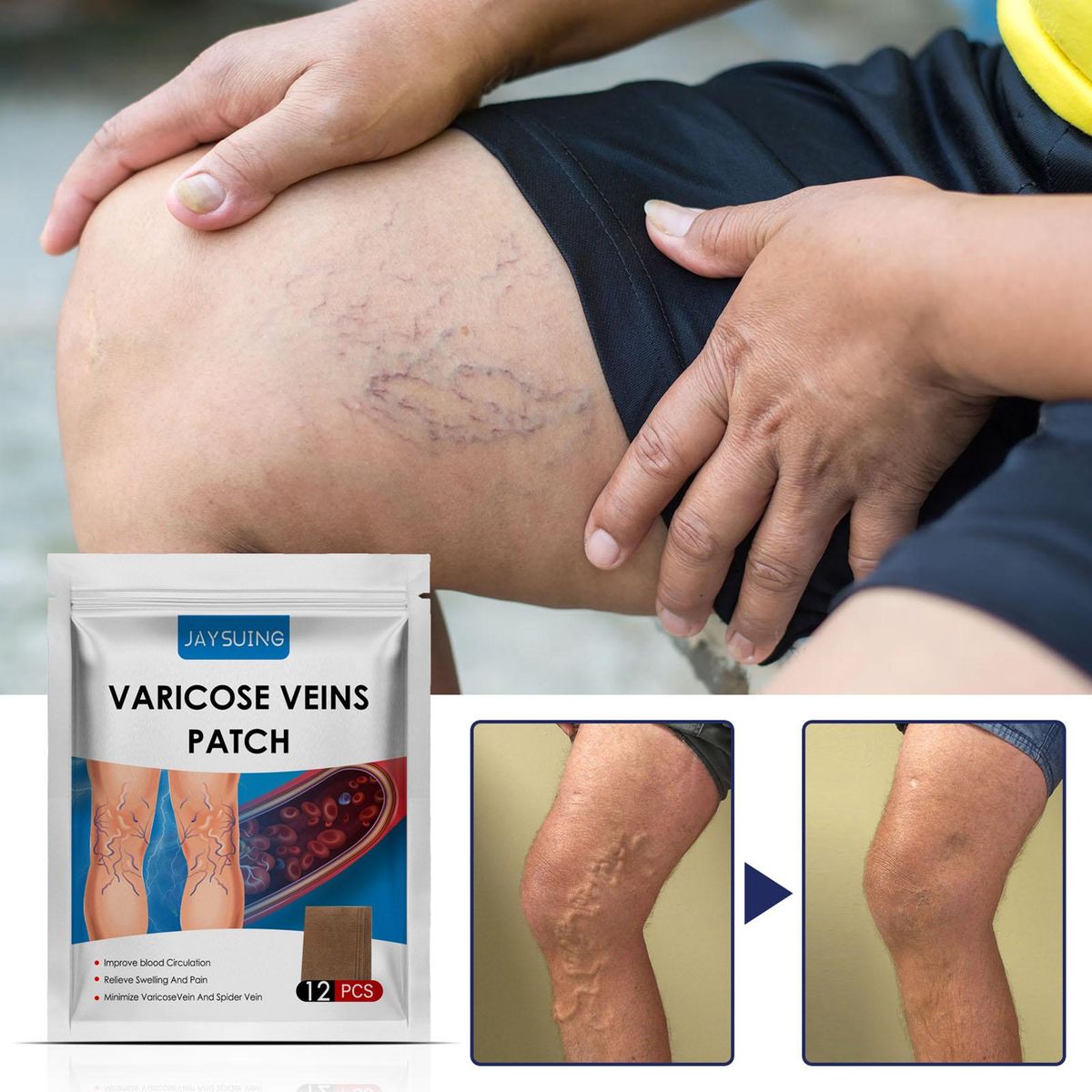 JAYSUING 12Pcs Varicose Veins Patches Skin-friendly Non-toxic Improve Varicosity Dredge Vein Relieve Soothe Swelling Pain