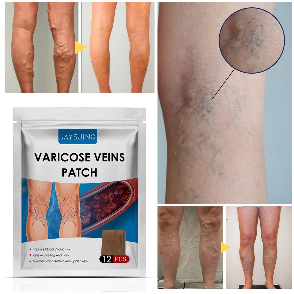 JAYSUING 12Pcs Varicose Veins Patches Skin-friendly Non-toxic Improve Varicosity Dredge Vein Relieve Soothe Swelling Pain