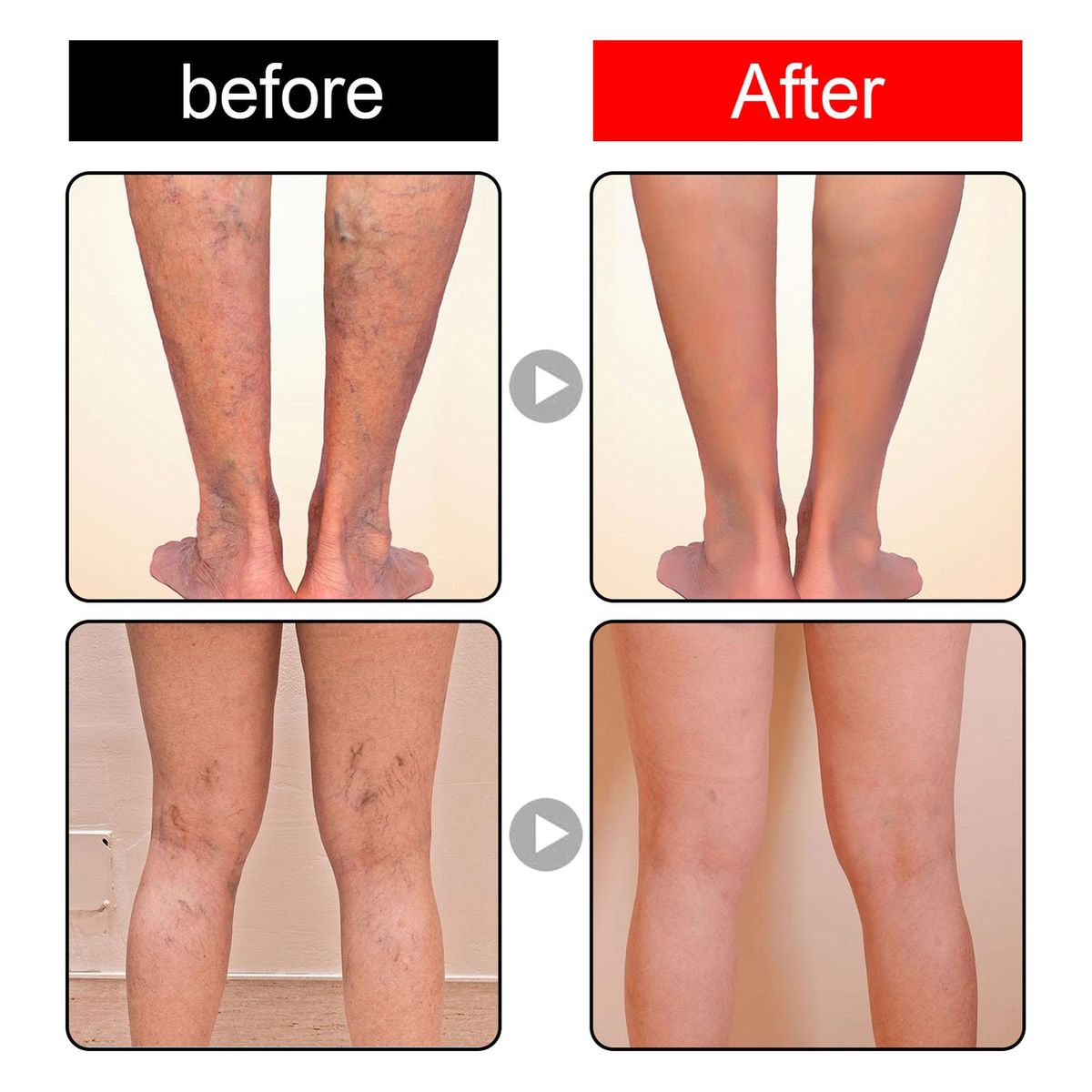 JAYSUING 12Pcs Varicose Veins Patches Skin-friendly Non-toxic Improve Varicosity Dredge Vein Relieve Soothe Swelling Pain