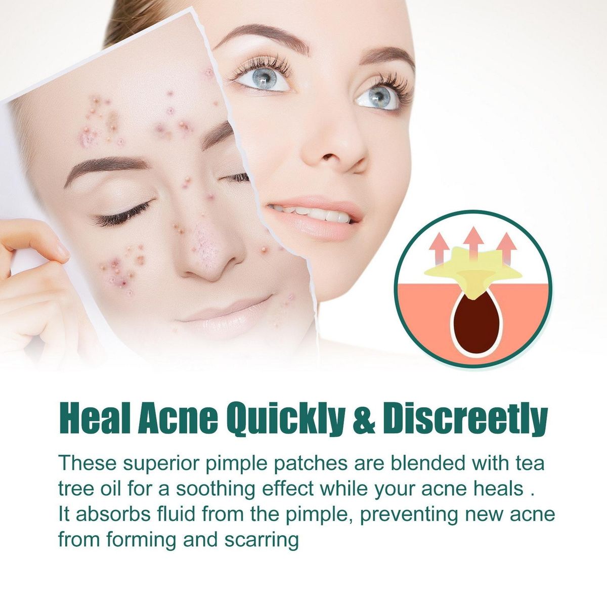 Acne Patches Star Relief Acne Stickers 112 Pcs Fast Repair for Marks