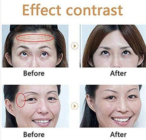 Anti- Aging, Dark Circle, Wrinkle, Puffy Eye Removal