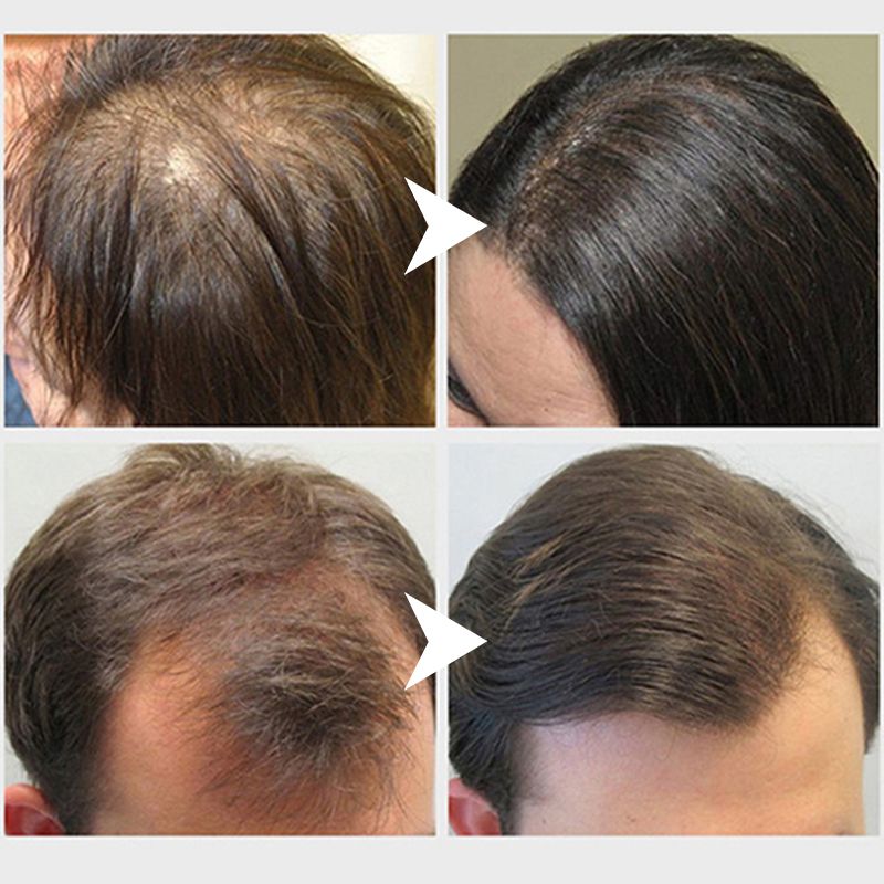 Natural Hair Growth Spray (Fast Action).