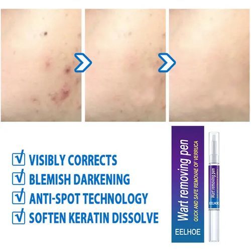 2pcs EELHOE Doctor Proven Verruca & Wart Removing Pen