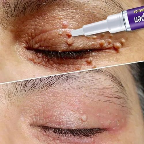 2pcs EELHOE Doctor Proven Verruca & Wart Removing Pen