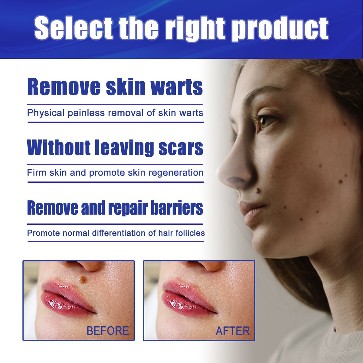 30Pcs Skin Tag Removal Rubber Band Warts Moles Removal Tool