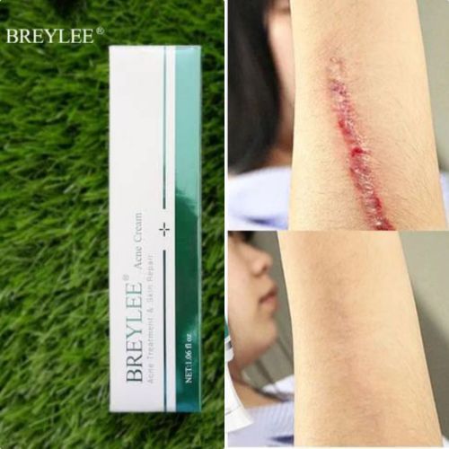 Scar Keloids Repair Cream. (Acne Scar Stretch Marks Remover Keloids Cream Skin Repair Face Cream Acne Spots Acne Treatment Blackhead Whitening Cream Skin Care)