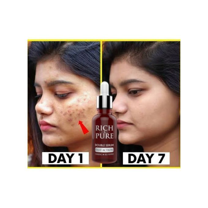 Rich & Pure Double Serum For Acne, Dark Spots & Sunburn Removal 30ml