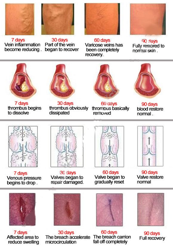 Patches Patch Treatment Herbal Varicose Veins For Treatmen Spider 5Pcs Varicose Natural Solution Cure Vasculitis Veins Plaster A