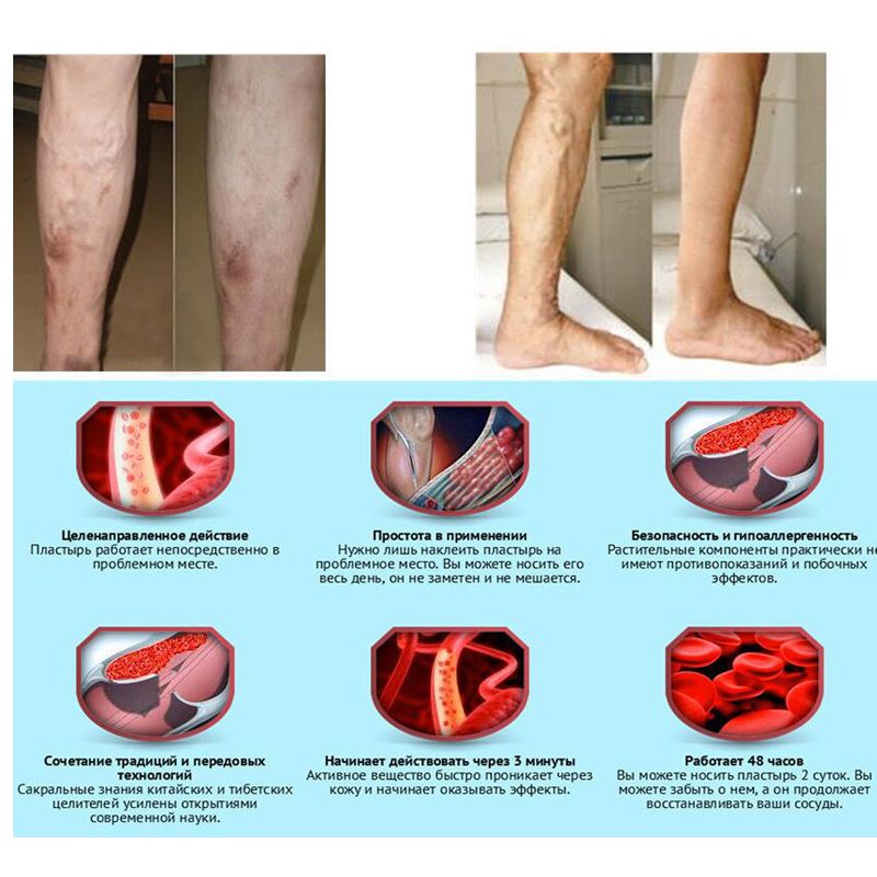 Patches Patch Treatment Herbal Varicose Veins For Treatmen Spider 5Pcs Varicose Natural Solution Cure Vasculitis Veins Plaster A