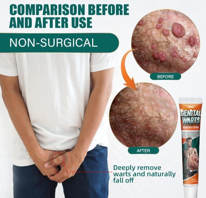 Powerful Genital Wart Removal Cream-20g