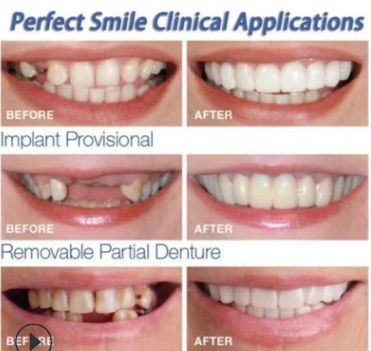 Perfect Smile Teeth Fake Tooth Cover False Teeth Veneers