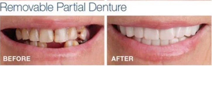 Perfect Smile Teeth Fake Tooth Cover False Teeth Veneers