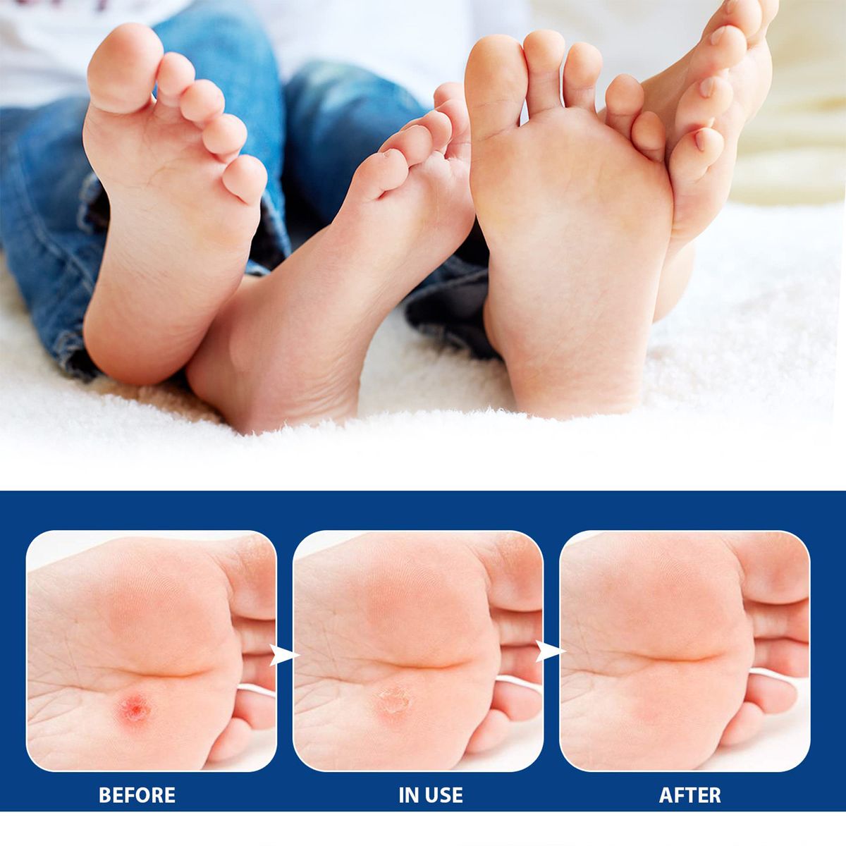 24Pcs Corn Removal Pads Remove Wart Calluses Relieve Pain