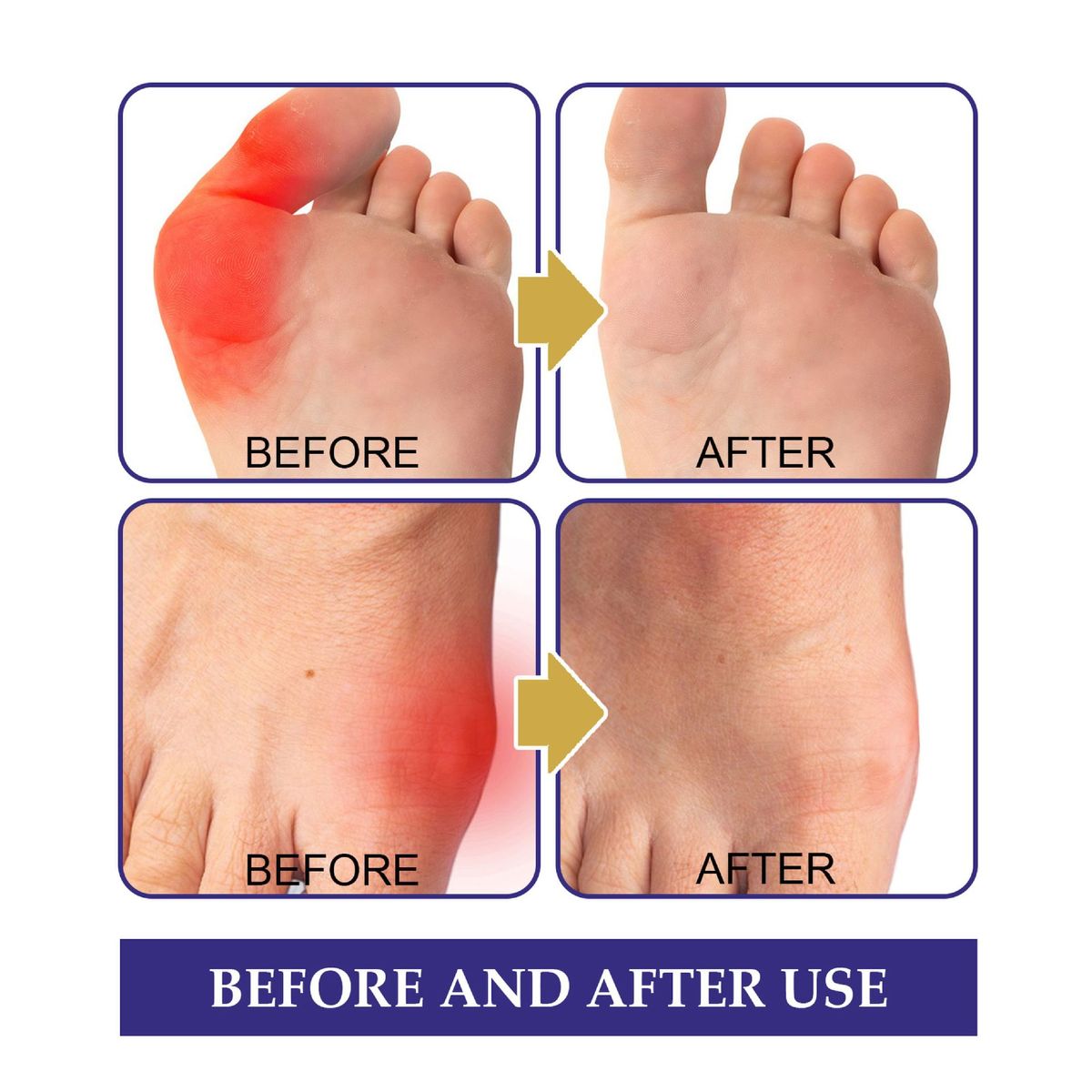 5Pcs Anti Bunion Patch Relieve Pain Prevent Bunion