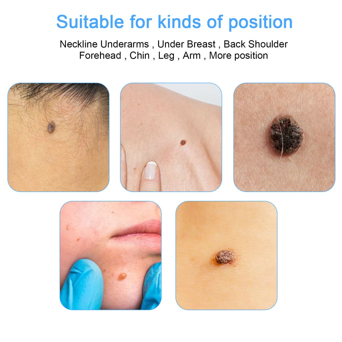 Remove Skin Tag Pen Two In One Facial Care Nevus Tool 2-8mm