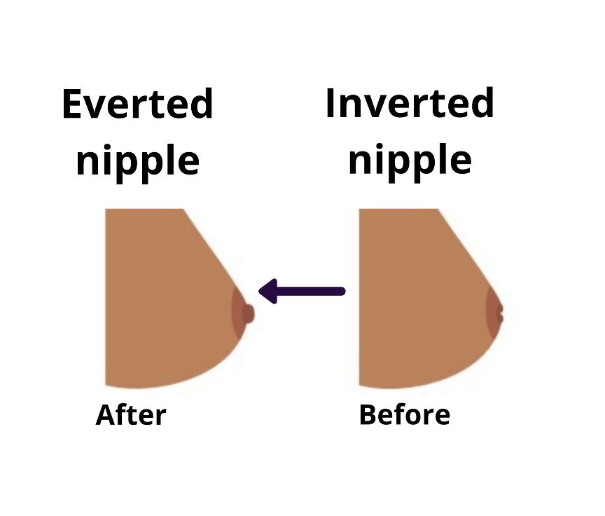 Nipple Corrector- For Flat & Inverted Nipples; 2pcs With A Storage Case