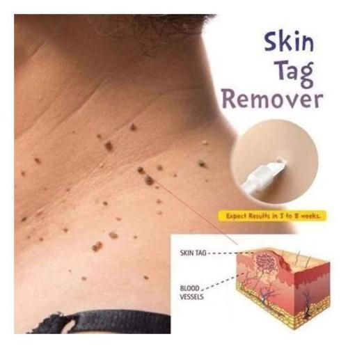 Skin Tag, Mole & Genital Wart, Foot Corn Removal 10ml