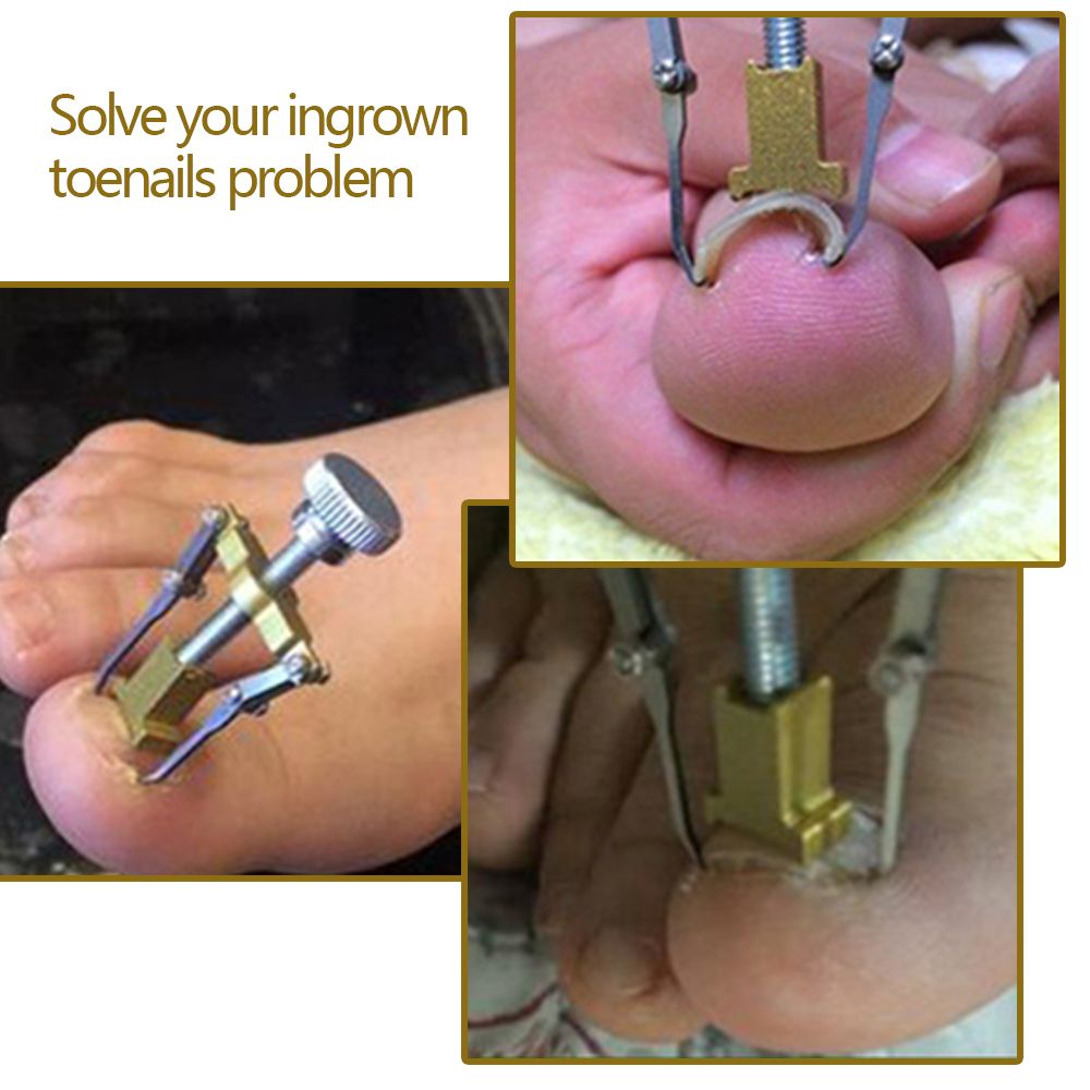 Professional Ingrown Toe Nail Correction Tool Toenail