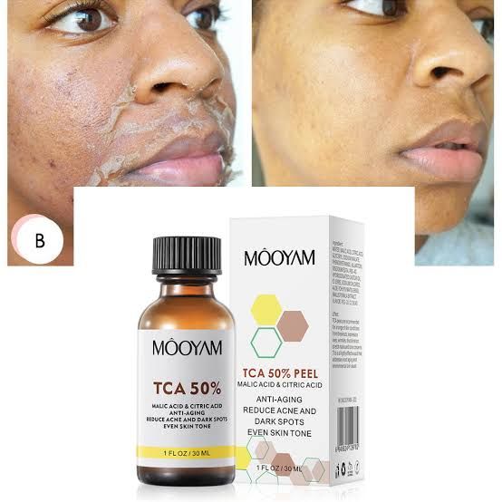 TCA Acid Skin Peel 50%