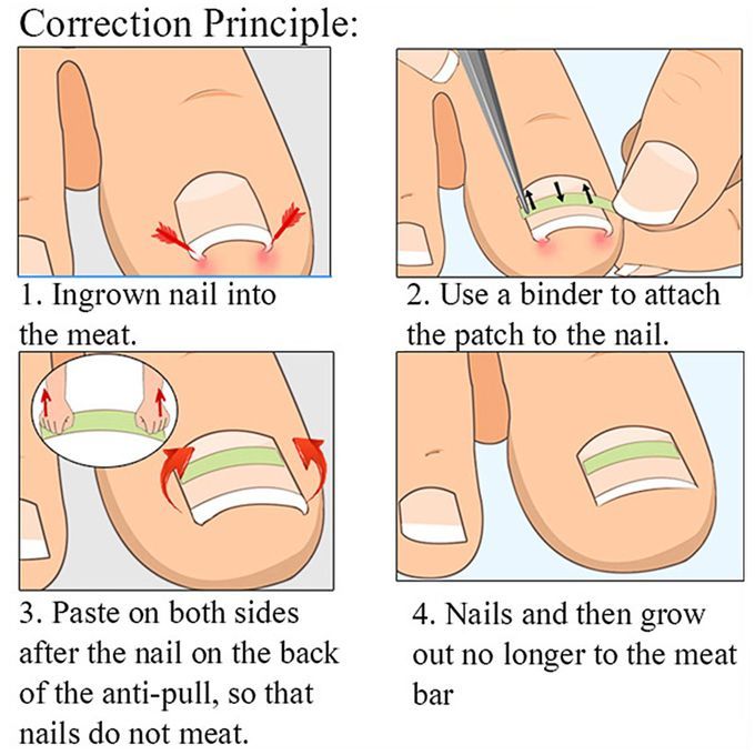 100PCS / 8 Size Ingrown Toenail Straightening Patch Toe