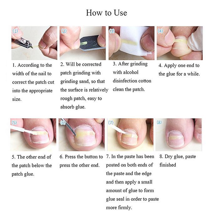 100PCS / 8 Size Ingrown Toenail Straightening Patch Toe