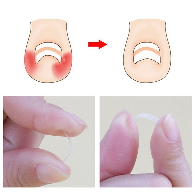 100PCS / 8 Size Ingrown Toenail Straightening Patch Toe