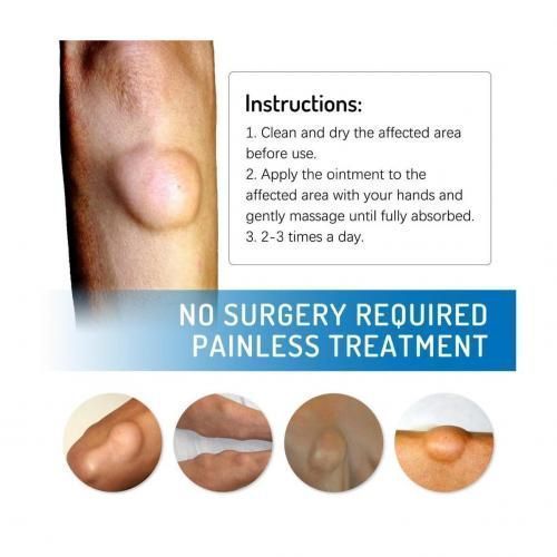 Effective Lipoma Removal Cream