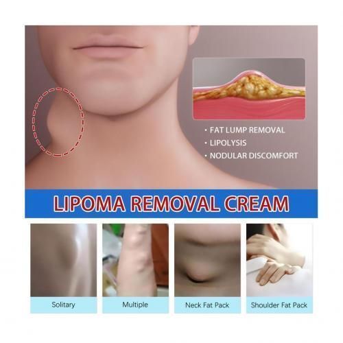 Effective Lipoma Removal Cream