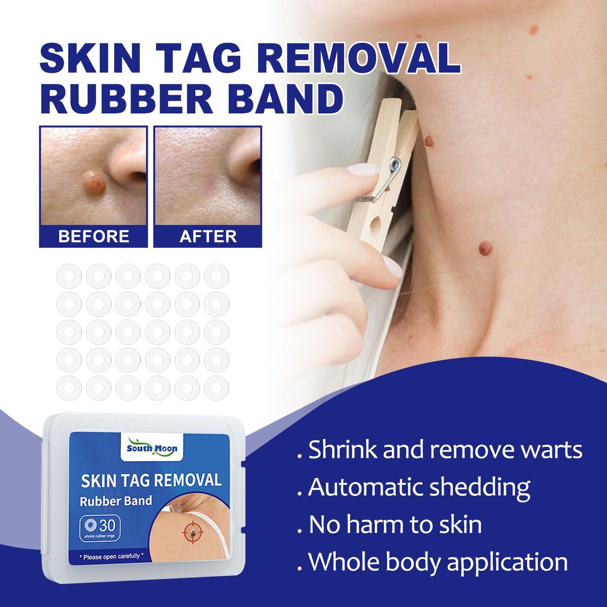 South Moon 30pcs/Box Mole Wart Remover Skin Tag Rubber Band Soften Keratin Painless Removal