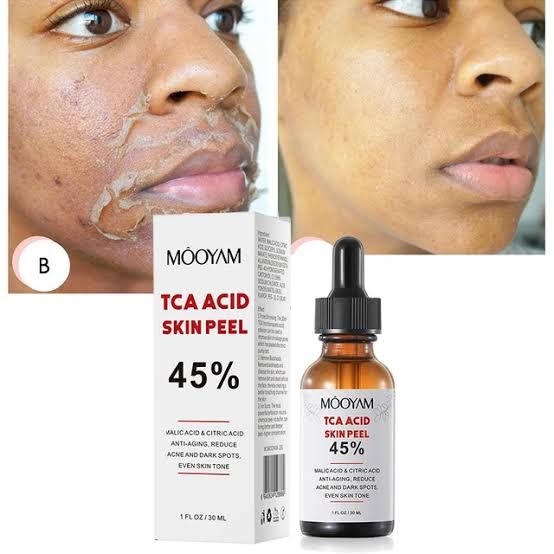 TCA Acid Skin Peel 45%