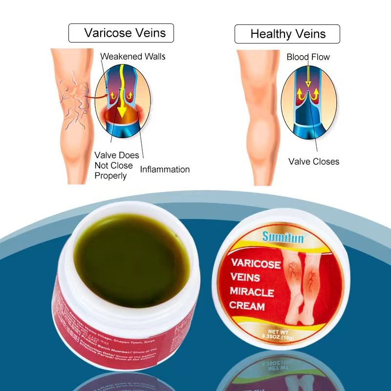 Varicose Vein Miracle Cream