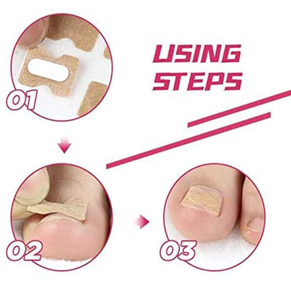 Ingrown Toenail Sticker Glue Free Toenail Patch Tools Kit