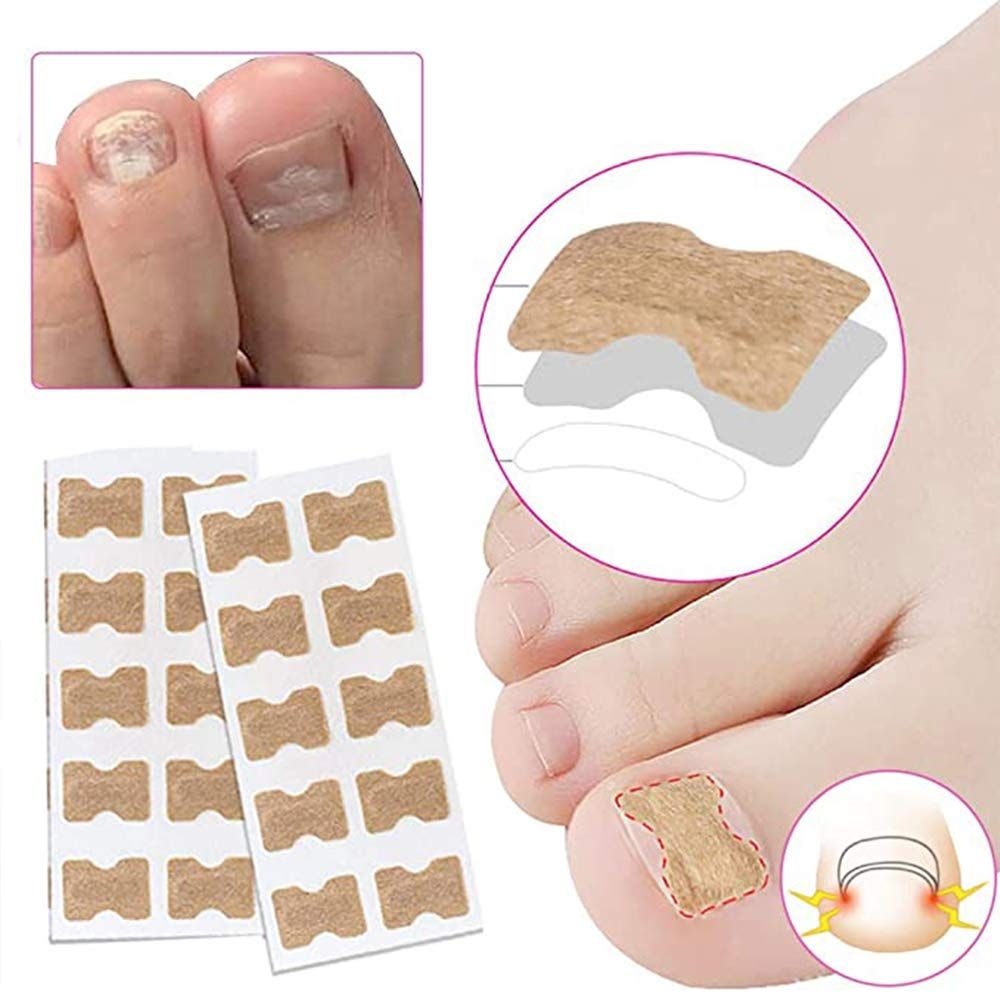 Ingrown Toenail Sticker Glue Free Toenail Patch Tools Kit