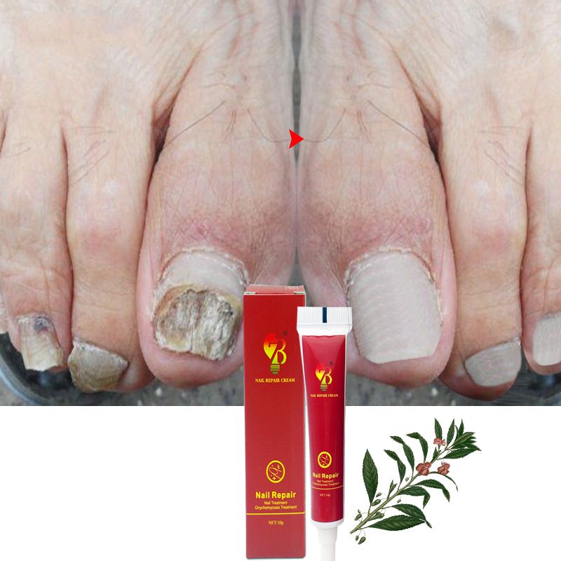 Repair Nail Care Skin Quality Nails Nail High Treatment Nail Tools Cream Fungus Cream Care Protector Herb