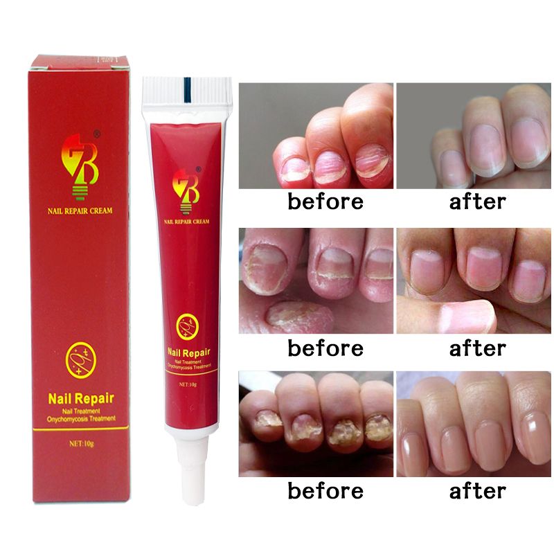 Repair Nail Care Skin Quality Nails Nail High Treatment Nail Tools Cream Fungus Cream Care Protector Herb