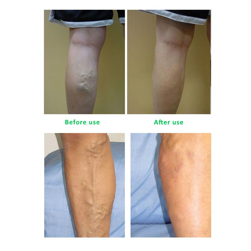Veins Plaster Relief Pain Pcs Vasculitis Herbal Chinese Cream Varicosity Spider 10 Remedy Patch Angiitis Veins Medicine Varicose