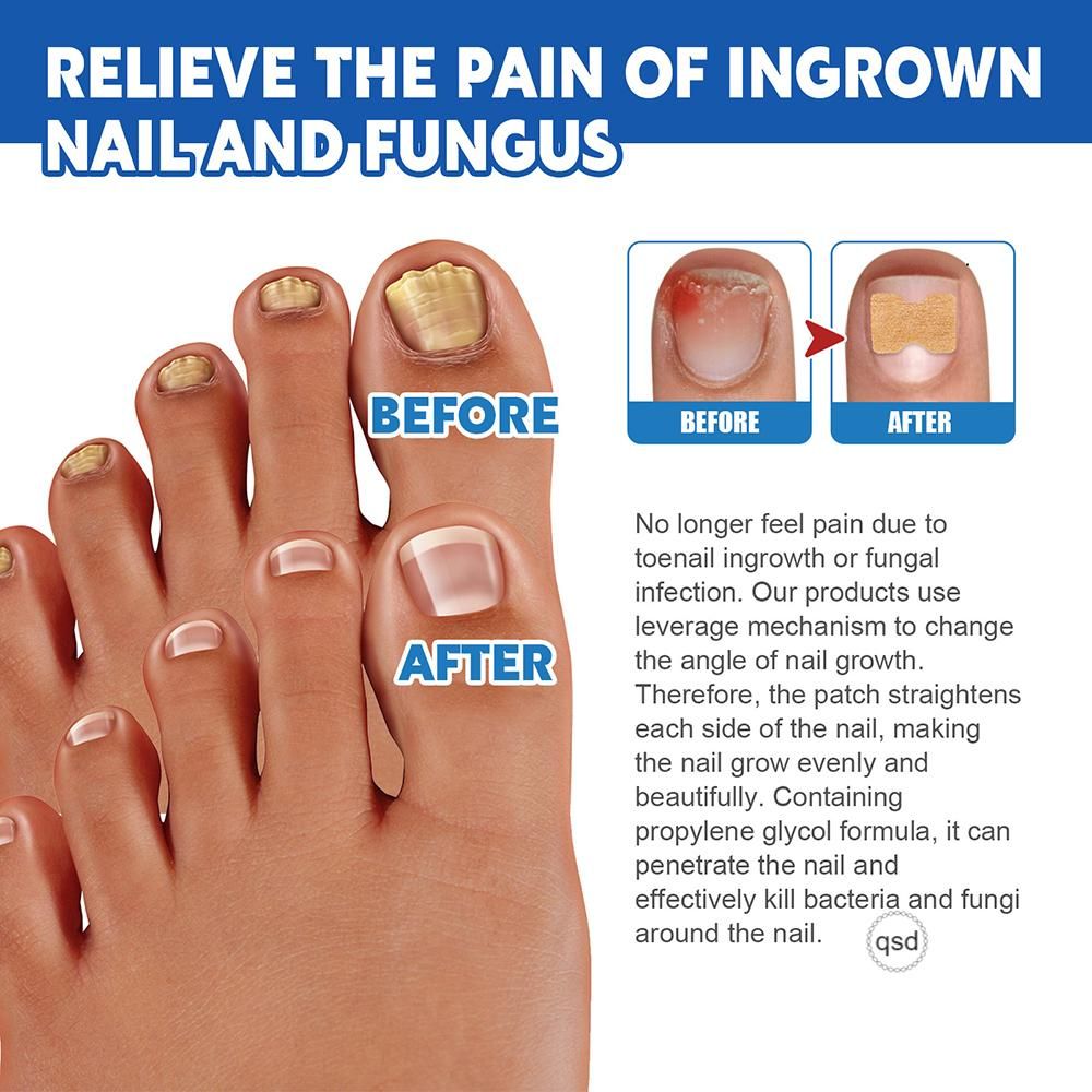 Ingrown Toenail Corrector Stickers Repairing Nails
