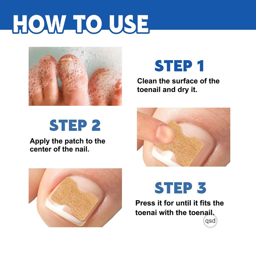 Ingrown Toenail Corrector Stickers Repairing Nails
