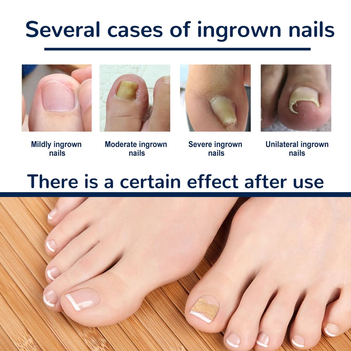EELHOE Toenail Correction Stickers Manicure Orthopedic
