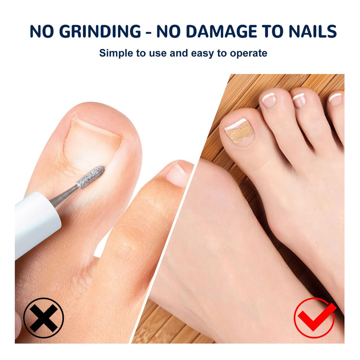EELHOE Toenail Correction Stickers Manicure Orthopedic