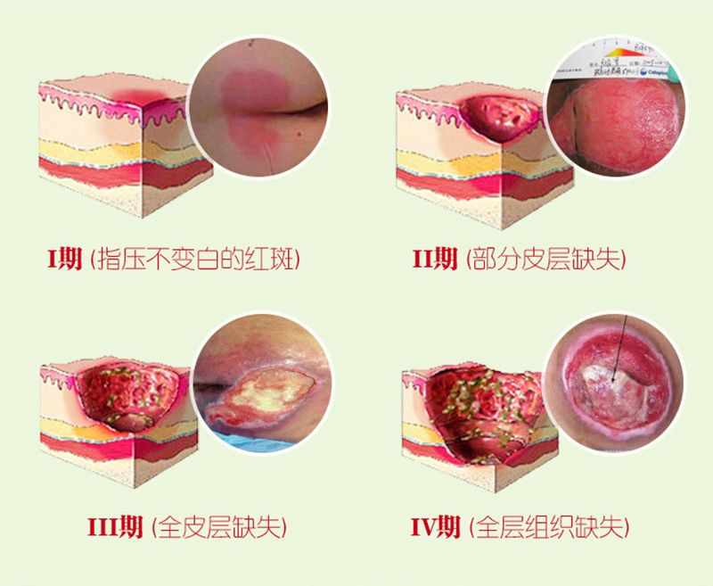Removal Sores/Decubituses/Pressure Rot Pressure Bedsores Myogenic Cream Festering Ulcer Herbal Healing Wound 1PC Treat Paste