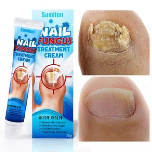 Nail Fungus Treatment Cream