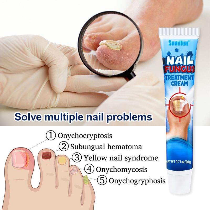 Nail Fungus Treatment Cream