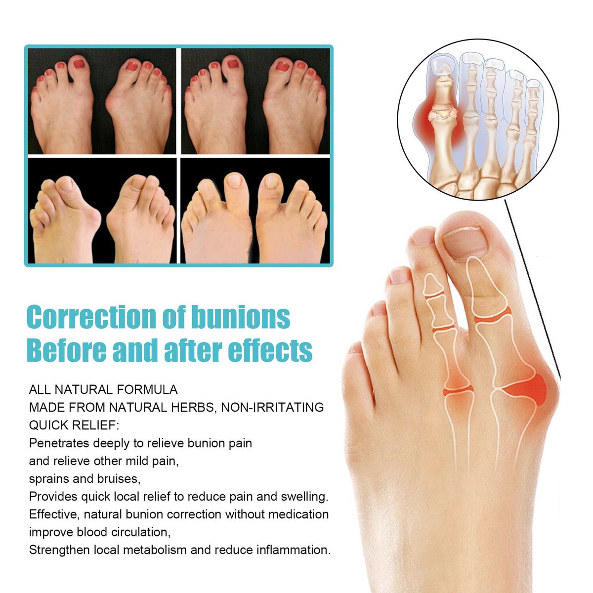 8PCS Bunion Patch Relief Bunion Swelling Pain