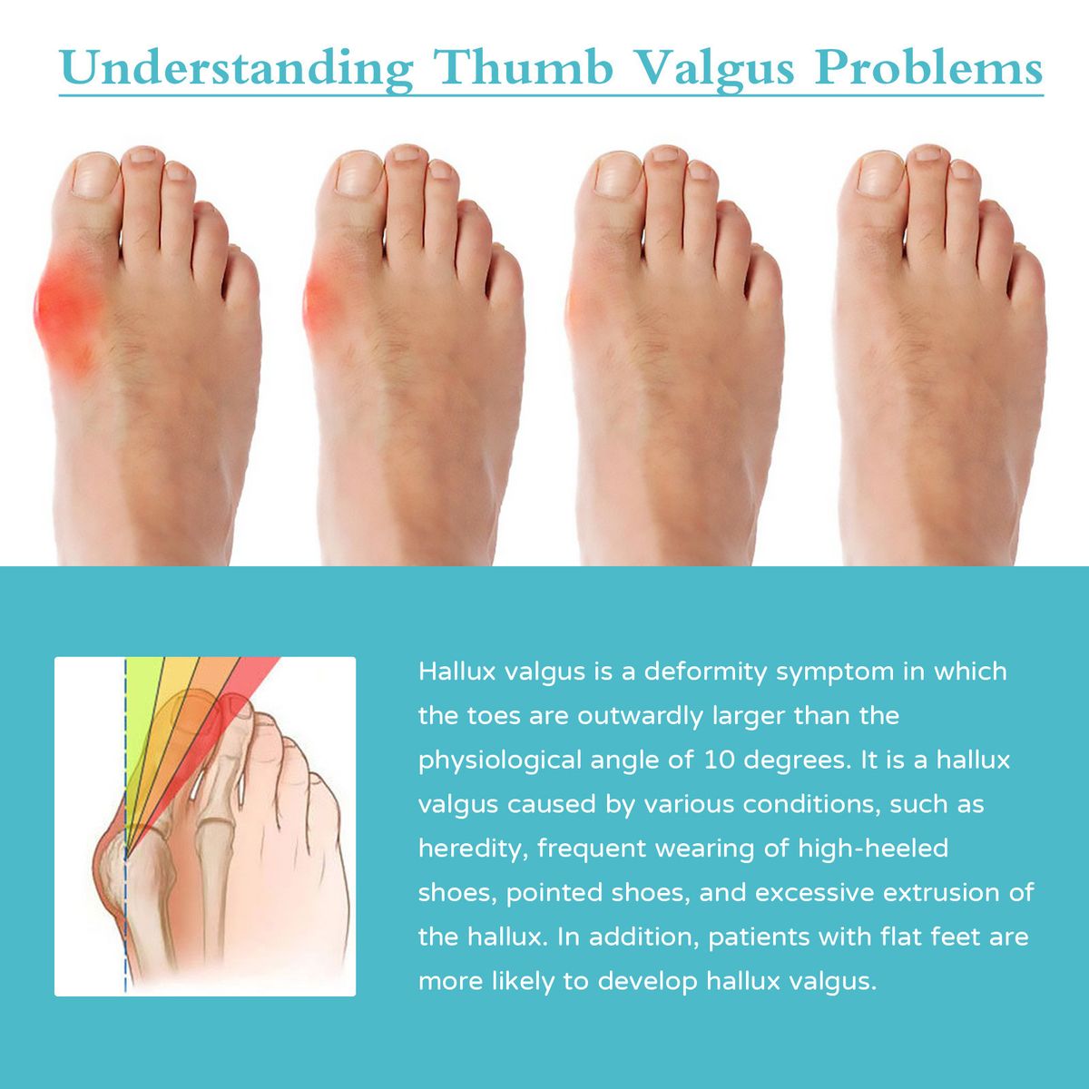 8PCS Bunion Patch Relief Bunion Swelling Pain