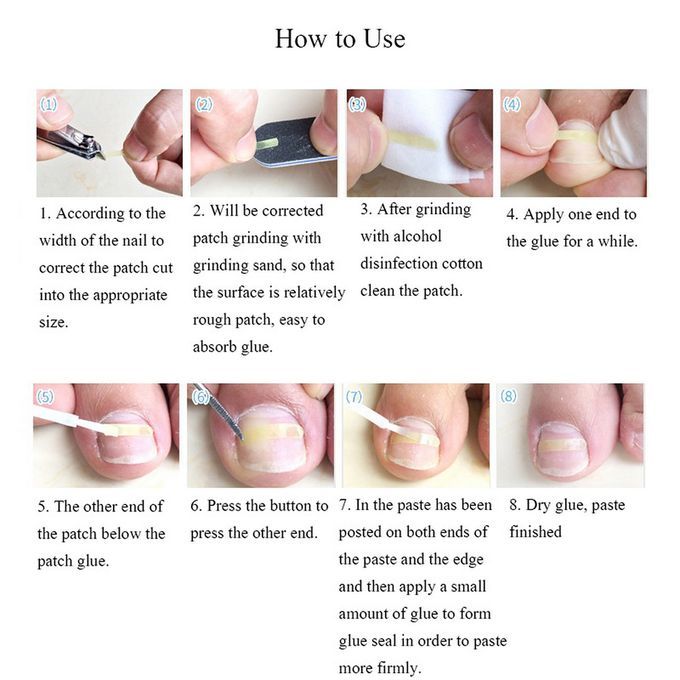 Ingrown Toenail Correction Set Toenail Treatment Toenail