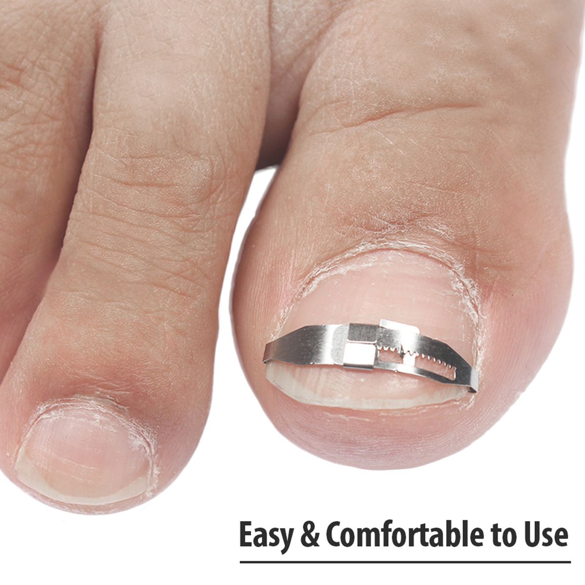 5pcs Ingrown Toenail Corrector Toenail Correction Treatment