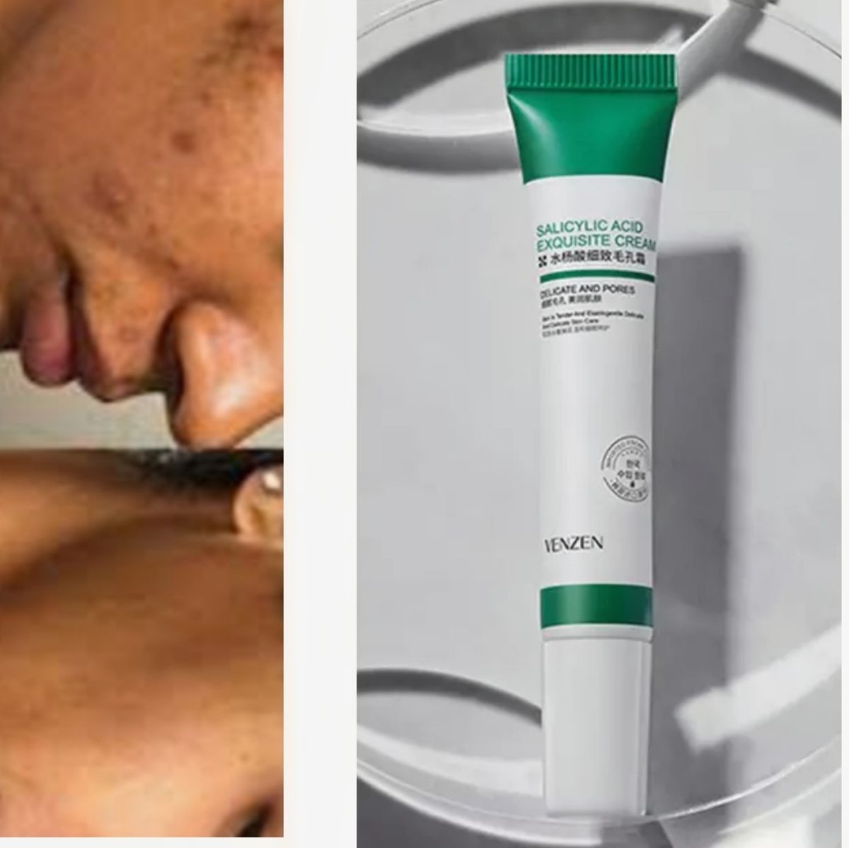 Salicylic Acid Acne Treatment & Scar Removal Cream