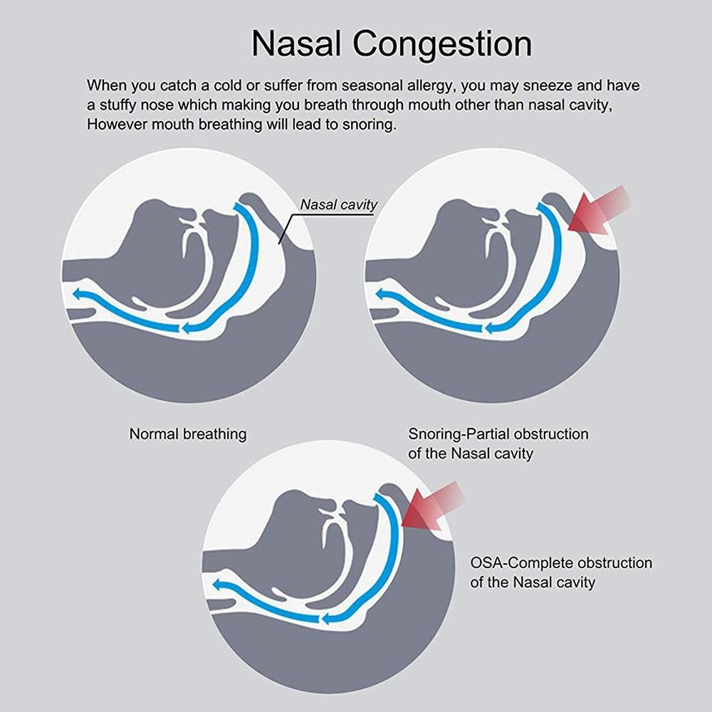 Anti Snoring Nasal Dilators Reduce Snore Nasal Congestion Relief for Better Breathing & Sleeping